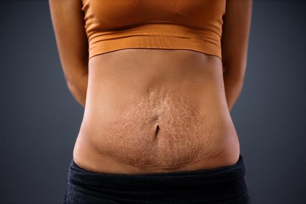 Scars after tummy tuck