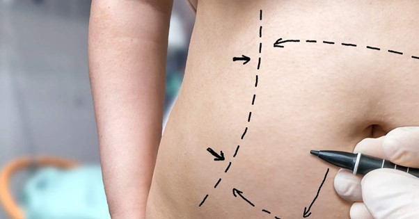 Tips for successful recovery after abdominoplasty